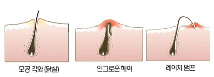 제모하는 여시들 짜증나는거 甲.jpg | 인스티즈