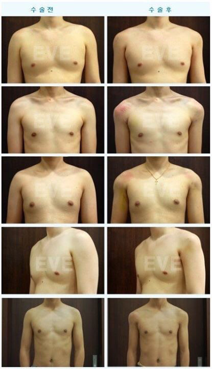 요즘 유행한다는 어깨수술.jpg | 인스티즈
