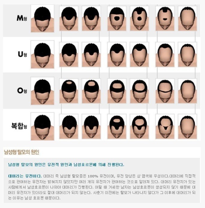 탈모의 유형 | 인스티즈